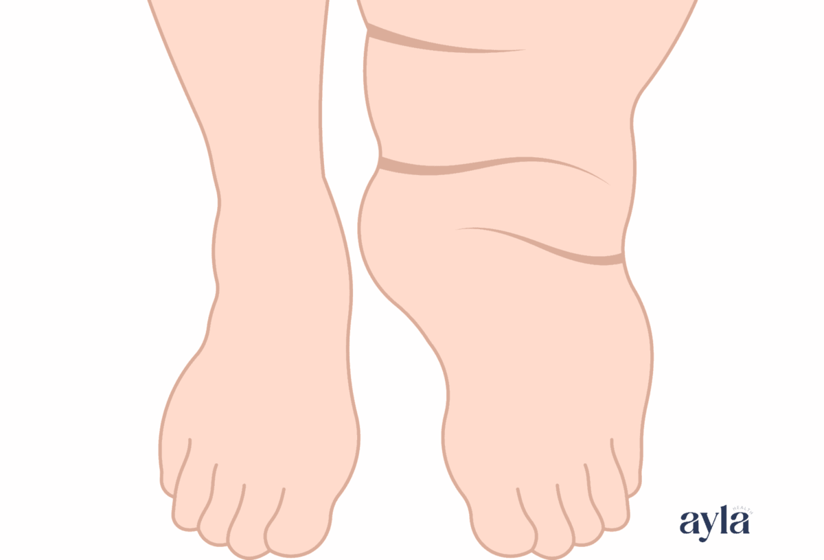 Lipoedema: Obesity or Something Else? - Ayla Health
